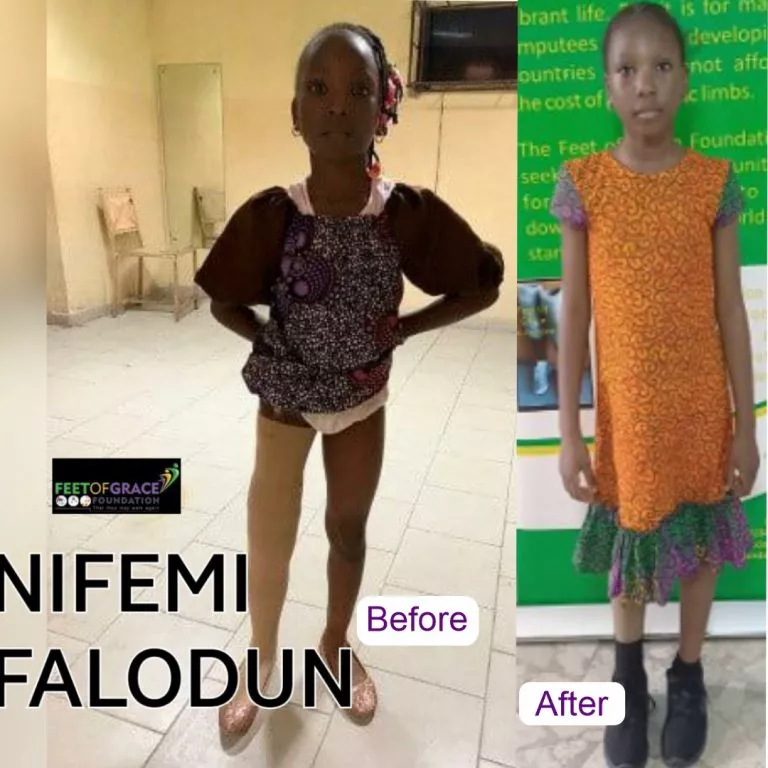 Nifemei Falodu, a beneficiary of Feet of Grace Foundation.